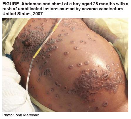 Compassionate Use in Treatment of Vaccine Complications 2007 28-month old child 1-3 Diagnosed with eczema vaccinatum after contact with his father, an active U.