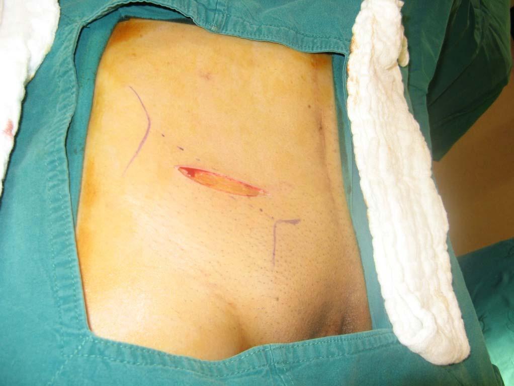 Incision along lower