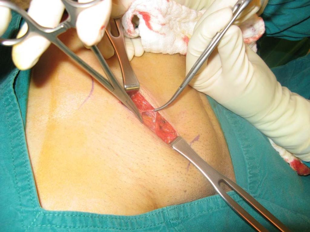 Incision along Aponeurosis of EOM.