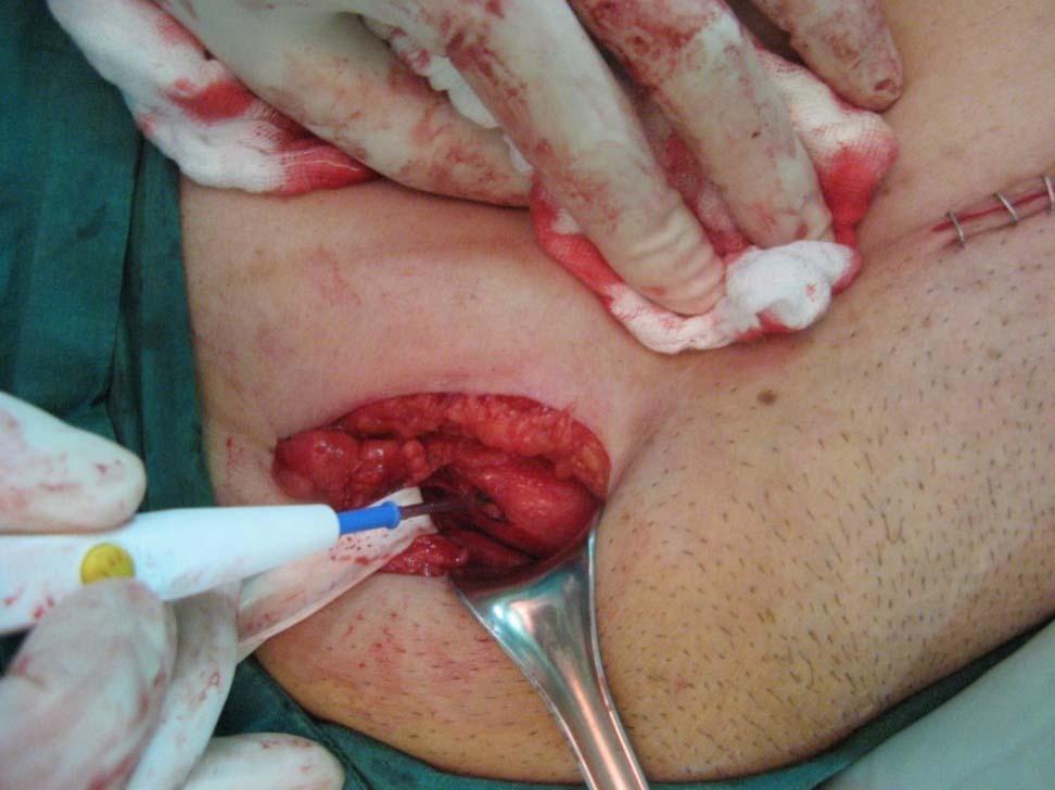 In Direct Inguinal Hernia, an incision is made at the