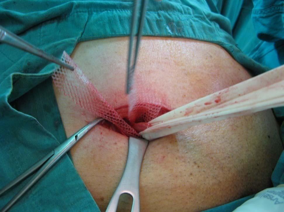 Place the onlay patch to cover the inguinal floor