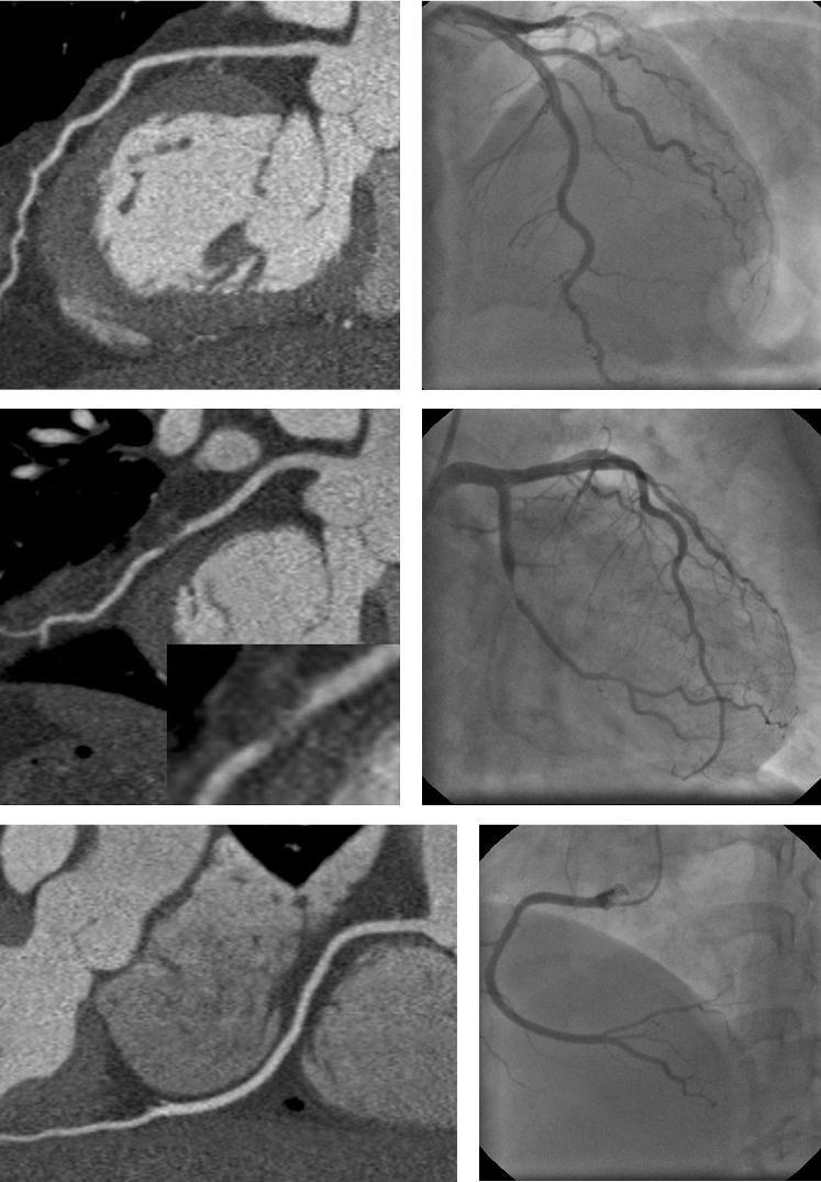 Figure 1 Thirty-eight-year-old patient with chronic stable angina.
