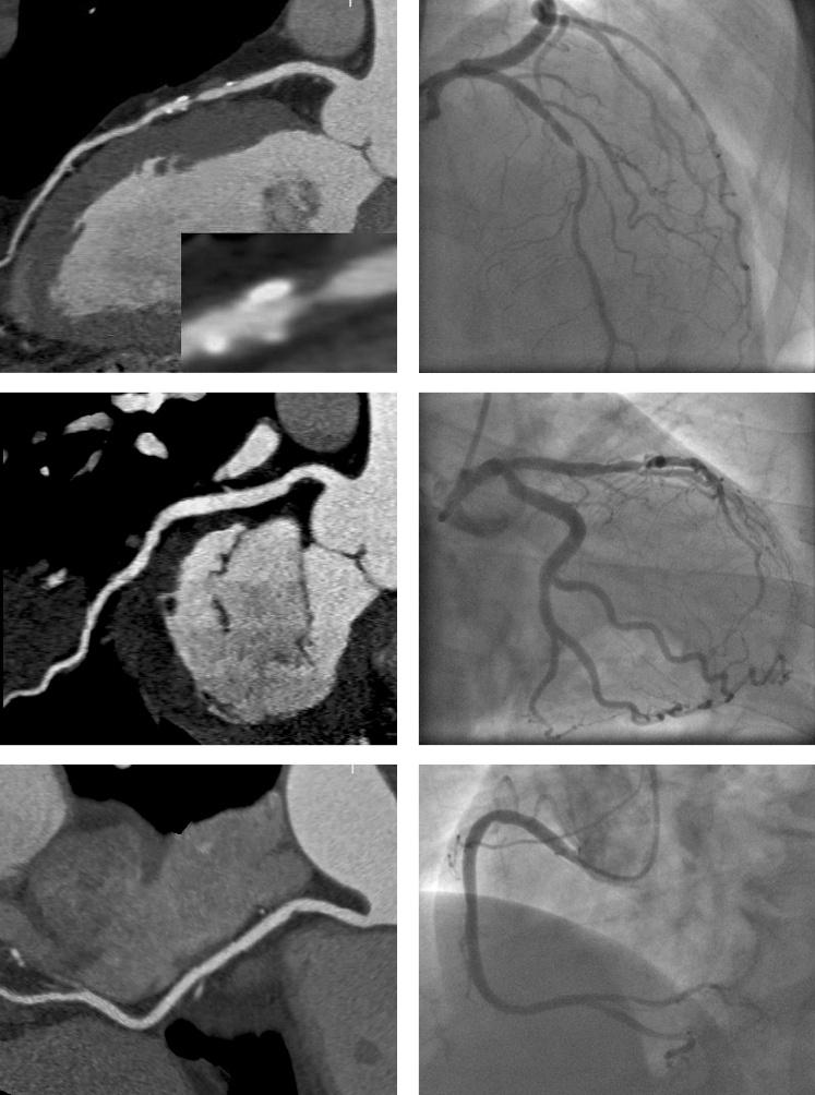 Figure 2 Patient with high-grade LAD stenosis in the presence of calcium detected by dual-source CT and validated with invasive coronary angiography.