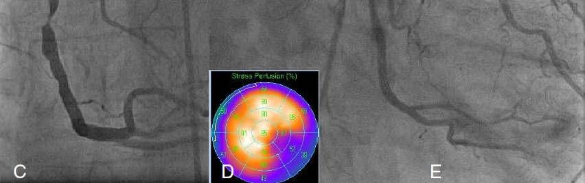 the angiogram Myocardial perfusion imaging