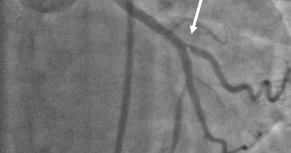 Use and utility of FFR during Bifurcation PCI After main branch stent implantation After stentingthe main branch, the ostiumof the side branch often