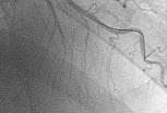 Use and utility of FFR during Bifurcation PCI After main branch