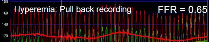 FFR in sequential stenoses Start the pull-back recording