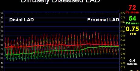 FFR in diffuse disease The only way to demonstrate the hemodynamic impact of diffuse disease is to perform a careful pull-back maneuver of the pressure sensor under steady-state maximal hyperemia In