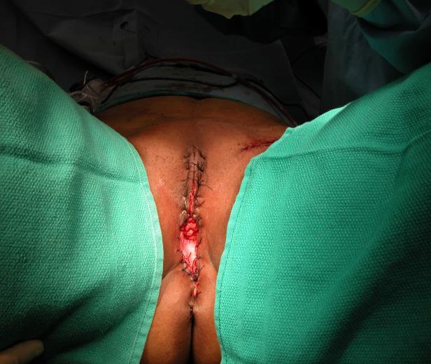 bilateral inguinal / femoral lymphadenectomy