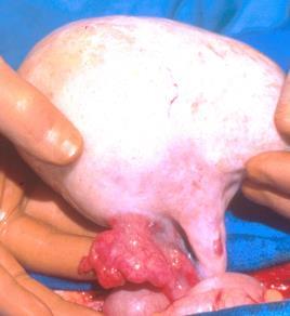 sinus tumor Embryonal carcinoma Ovarian