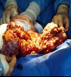 Removal of diaphragmatic and peritoneal implants Splenectomy, appendectomy % 5 yr Survival