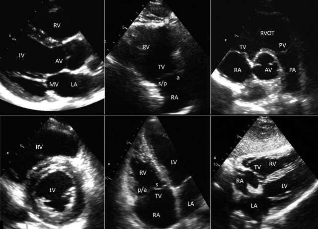 Standard RV views by echo anterior & inferior RV walls, RV inflow tract two leaflets RV anterior wall prox part of RVOT basal part of RV anterior wall, RVOT, two leaflets, pulmonary valve PA RV