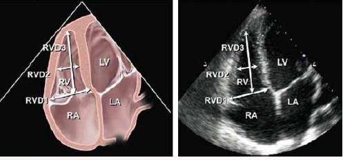 RV focused view Avoid underestimation Rotate the transducer until the maximal
