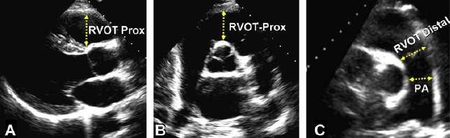 RVOT size The PSAX distal RVOT diameter, just proximal to the pulmonary annulus, is the most reproducible and