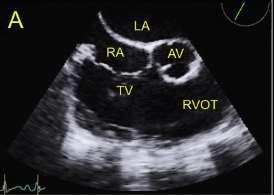 Transoesophageal echo Some segments of the RV, such as the RVOT contributing up to 25 30% of the RV volume, could be overlooked when using standard transthoracic 2DE