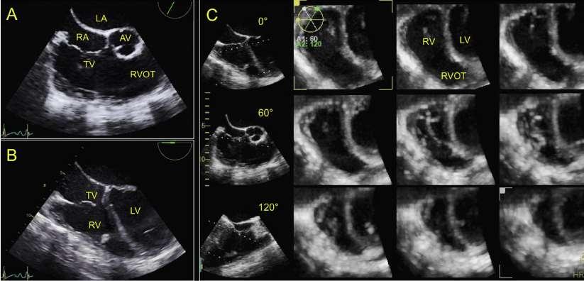 TEE is essential in the peri- and intraoperative settings and allows continuous monitoring of right heart function during noncardiac surgery In addition to standard