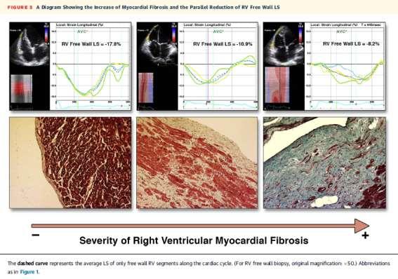 RV tissue characterisation RV freewall strain may be an accurate echocardiographic marker of the extent of RV myocardial
