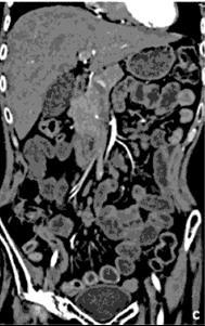 98% of the patient with thickened bowel walls had submucosal layer involvement. Simultaneous involvement of mucosa and submucosa was noted in 13.73% of the cases.