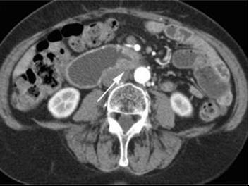 Mesentery involvement Involvement of mesentery in the form of mass/fat stranding or vascular engorgement was seen overall in 26.19% of the patients and in 50.