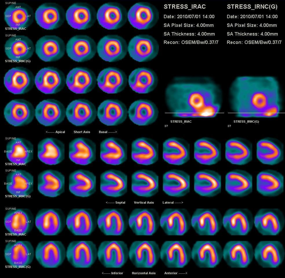 Myocardial perfusion study Can the study be stopped after the normal stress images?