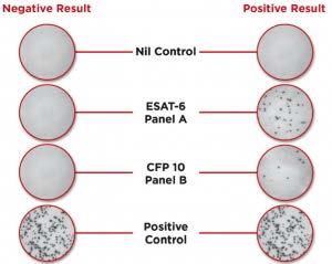 T-SPOT Interpretation Positive Negative Borderline Indeterminate T Spot TB 8 spots* 4 spots* 5-7 spots*