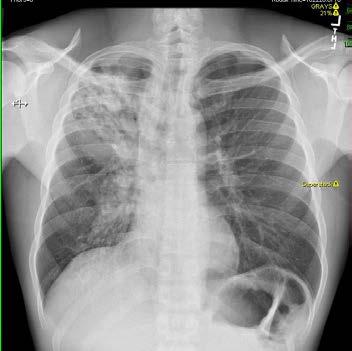 Example TB infection Diagnostic Algorithm At-risk person Tuberculin test/igra + symptom review Negative Positive (symptoms OR TST/IGRA) Chest x-ray LTBI