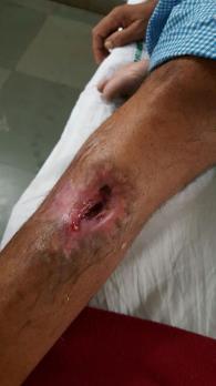 Dressing was done every 48 hours until healthy granulation tissue appeared covering the wound. Result There were total 73 patients with mean age of 40 years.