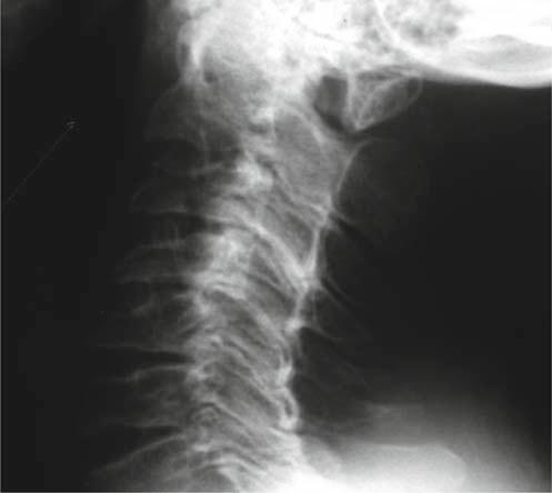 34, Pltyspondyly nd nrrow disc spces on nteroposterior () nd