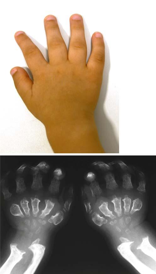 Common Bone Dysplsis nd Mlformtions Chpter 1 17 Fig. 1.40, The hnd is reltively smll ut wide, the fingers re shortened ().