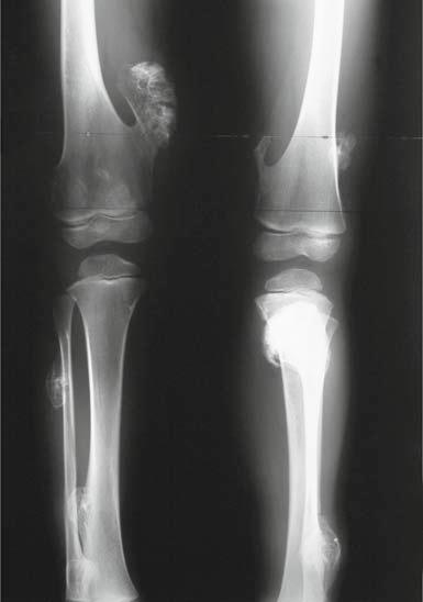 51 Lrge tiil, fiulr, nd femorl osteochondroms, with deformity of the extremities c d Fig.