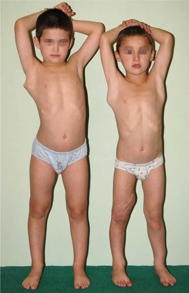 The oys re cousins, 4 nd 6 yers, oth of them hve osteochondrom developing from the right