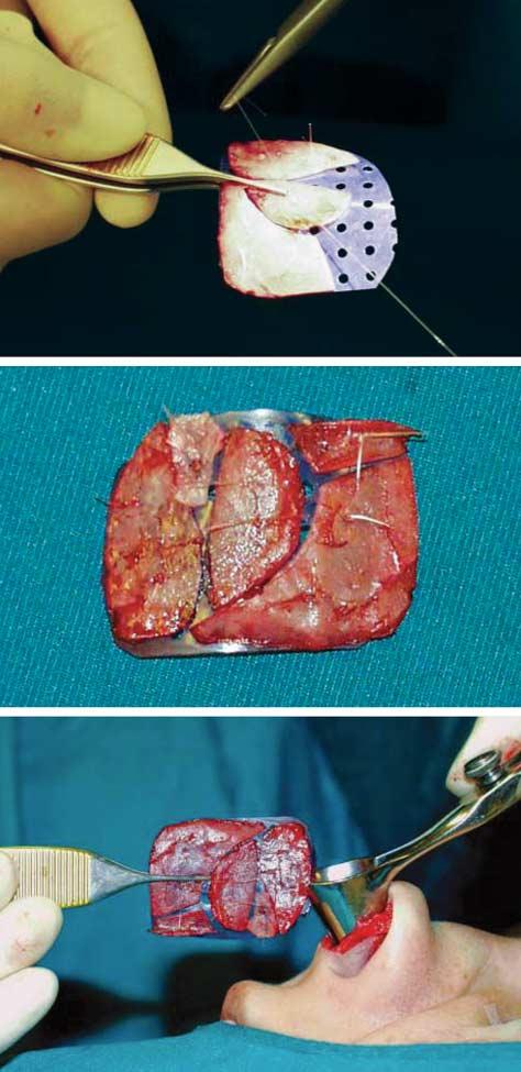 A B C Figure 6. Polydioxanone (PDS) plate surgical technique. A, Cartilage fragments are sutured to the PDS plate. B, The finished graft. C, The graft is reimplanted into the nose.