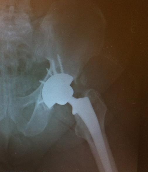 Goals of Acetabular Reconstruction 1. Utilization of cementless component (USA) 2. Intimate contact with host bone 3.