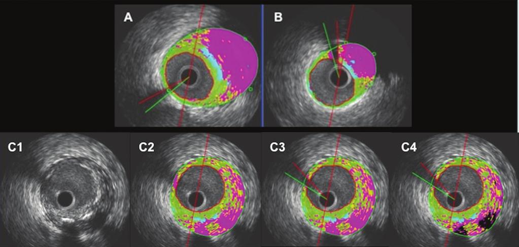 Reproducibility of Intravascular Ultrasound imap E241 Fig. 6. The information lost due to the wire shadow is depending on where the shadow is located.