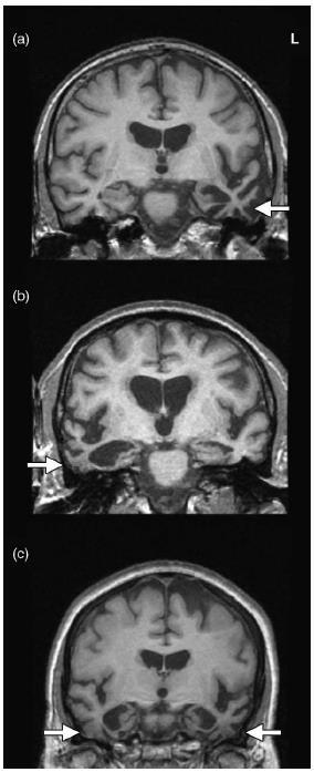 Semantic Dementia Circumscribed atrophy of anterolateral temporal lobes bilaterally but often