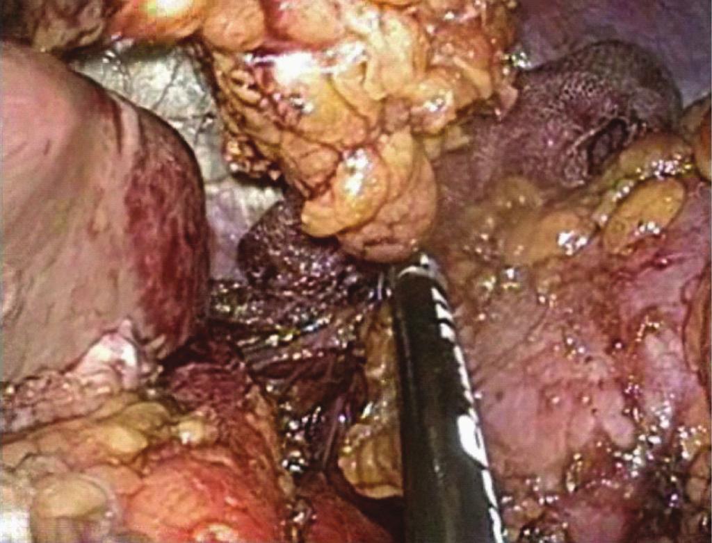 dissection of the junction of the colonic