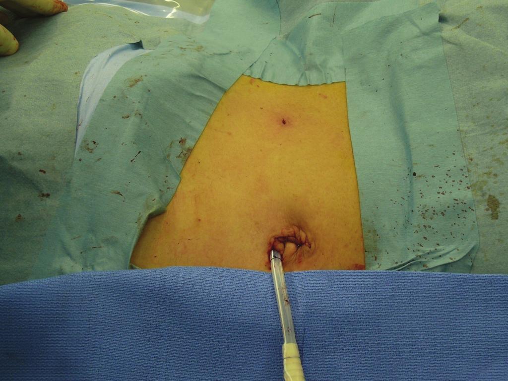 4 In the current cases, we used a 12-mm trocar for the laparoscope despite using a flexible 5-mm laparoscope, since we originally assumed usage with a rigid laparoscope (about 10 mm in diameter).