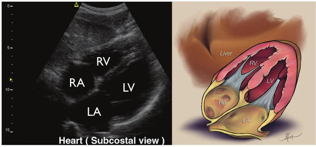Image 10: Probe placement for a subxiphoid view of the heart during an efast exam. Image 11: Subxiphoid ultrasound of the heart and all four chambers.