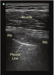 Visualize the hypoechoic ribs of the chest wall. Identify the bright white pleural line just farfield to the ribs (Image 13).