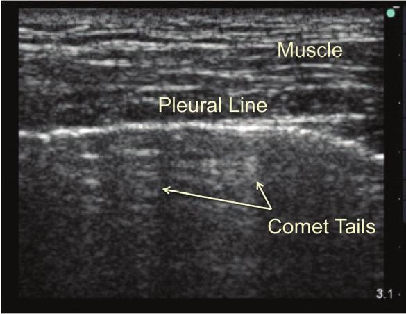 Page 13 of 21 Image 14: Normal lung ultrasound with hyperechoic comet tails coming off the pulmonary pleura.