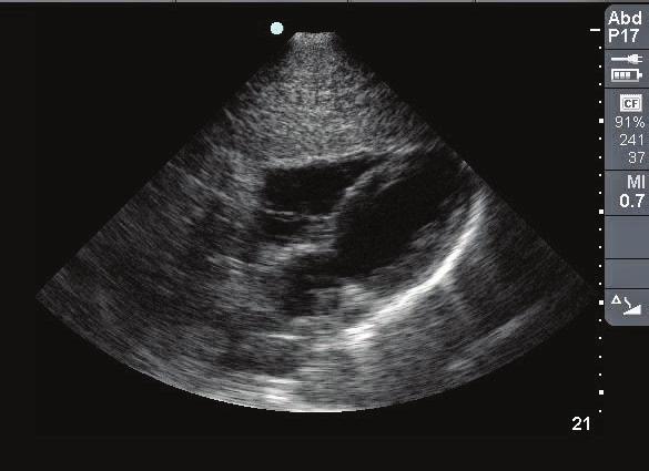 Image 18: Normal pericardial scan (subxiphoid