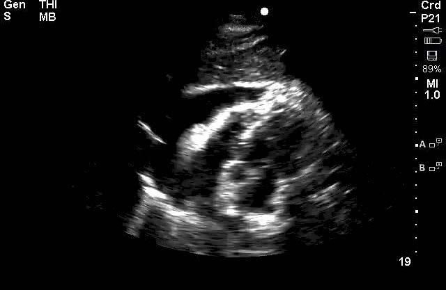 Image 26: Pericardial effusion surrounding the