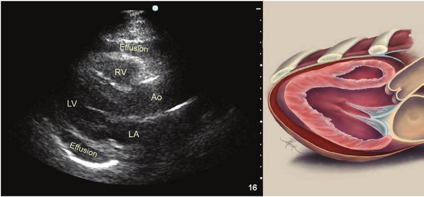 Image 27: Pericardial effusion surrounding the