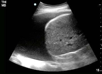 Image 30: Hemothorax seen above