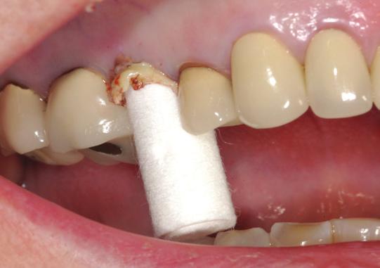 Traxodent has clinical versatility and can Crown and Bridge with Retraction Cap Using a retraction