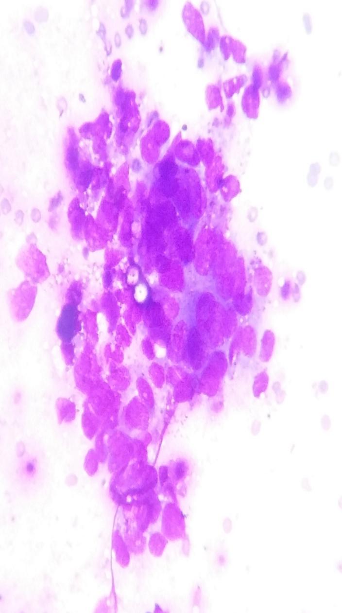 40X FIGUARE: 18 SQUAMOUS CELL