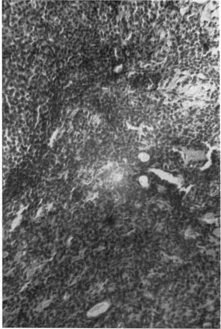 7.-Case 4, epitheliomatous infiltrations in lacrimal gland tumour, showing nests and acini of recuffent malignant mixed lacrimal gland epithelial cells in a myxomatoid matrix. x 120. tumour. x 120. Diagnosis.