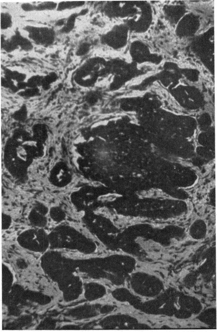 FIG. 8.-Case 5, left proptosis due to adenoidcystic carcinoma of lacrimal gland of 2 months' duration in a man aged 46 years. FIG. 10.