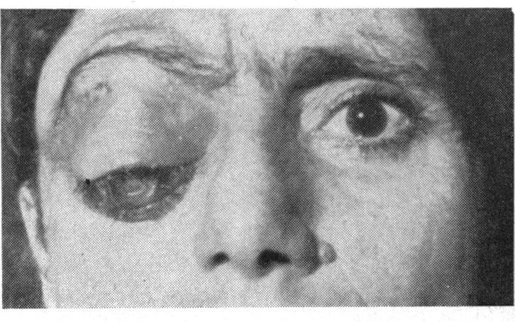 ). The tumour was vascular and non-encapsulated. FIG. 1.-Case 8, right recurrent proptosis due to recurrent carcinoma of lacrimal gland of 5 months' duration in a woman aged 49 years. Histology.