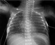 Chronic lung disease of infancy (Bronchopulmonary dysplasia) BPD complicated